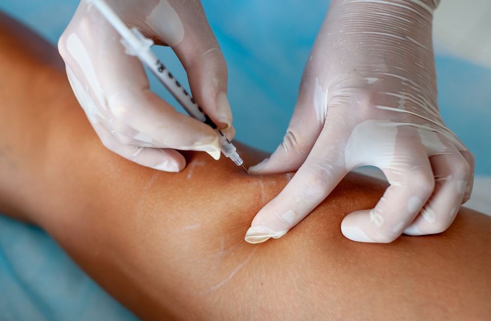 doctor guantes medicos introduce escleroterapia piernas mujer cerca