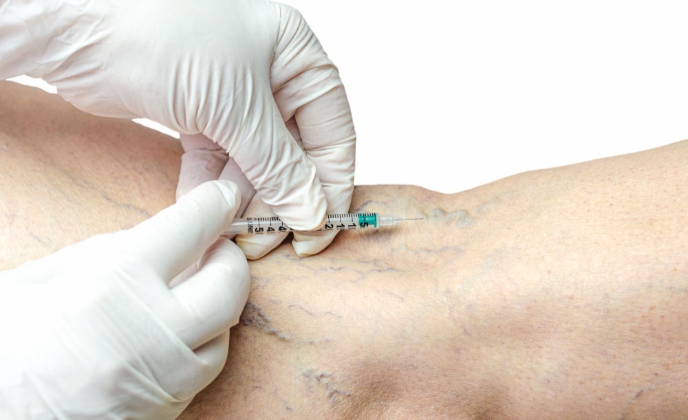 Sclerotherapy2