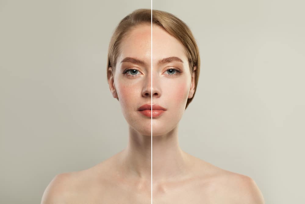 laser treatment for skin resurfacing