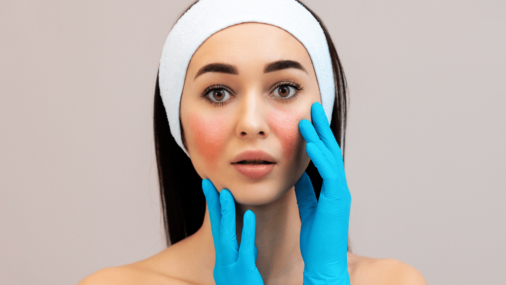 Rosacea skin