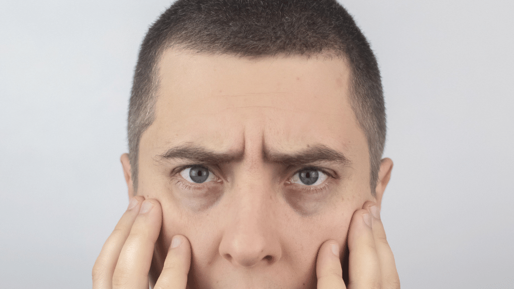Revitalize-Your-Eyes-with-Tear-Trough-Treatments-at-Vi-Beauty-Lab